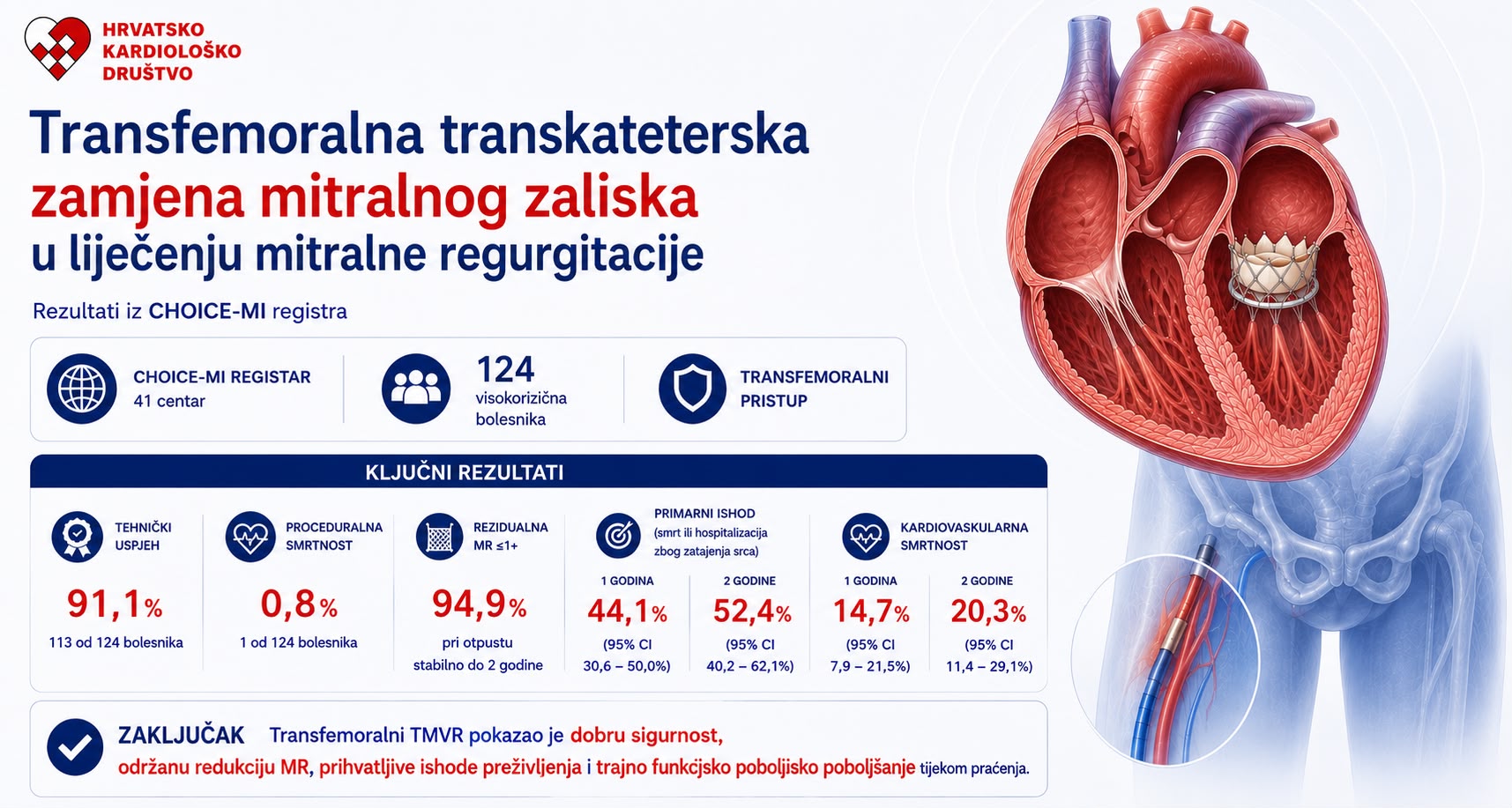 Transfemoralni pristup u fokusu liječenja mitralne regurgitacije