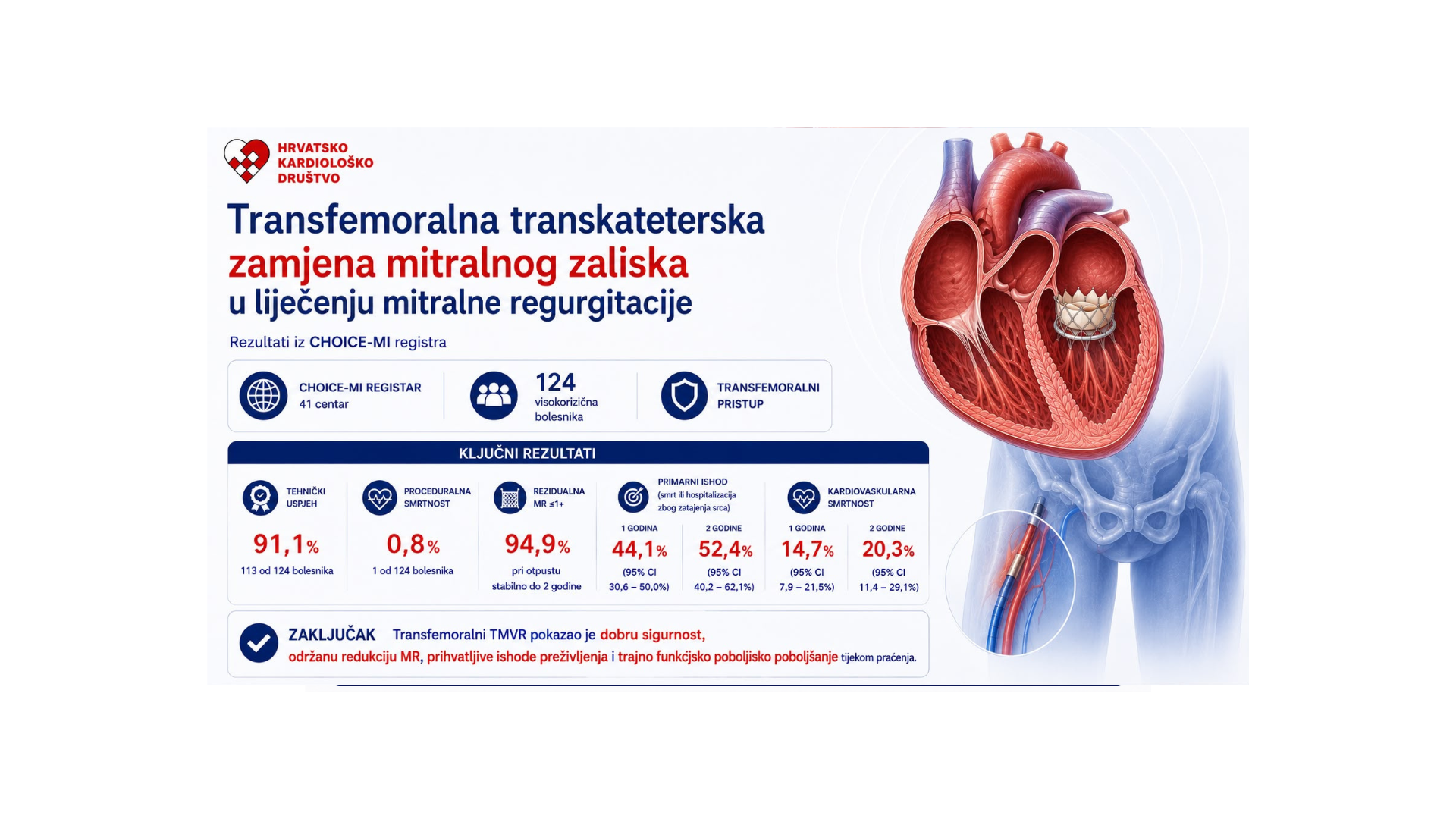 Transfemoralni pristup u fokusu liječenja mitralne regurgitacije